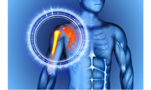 shoulder impingement?