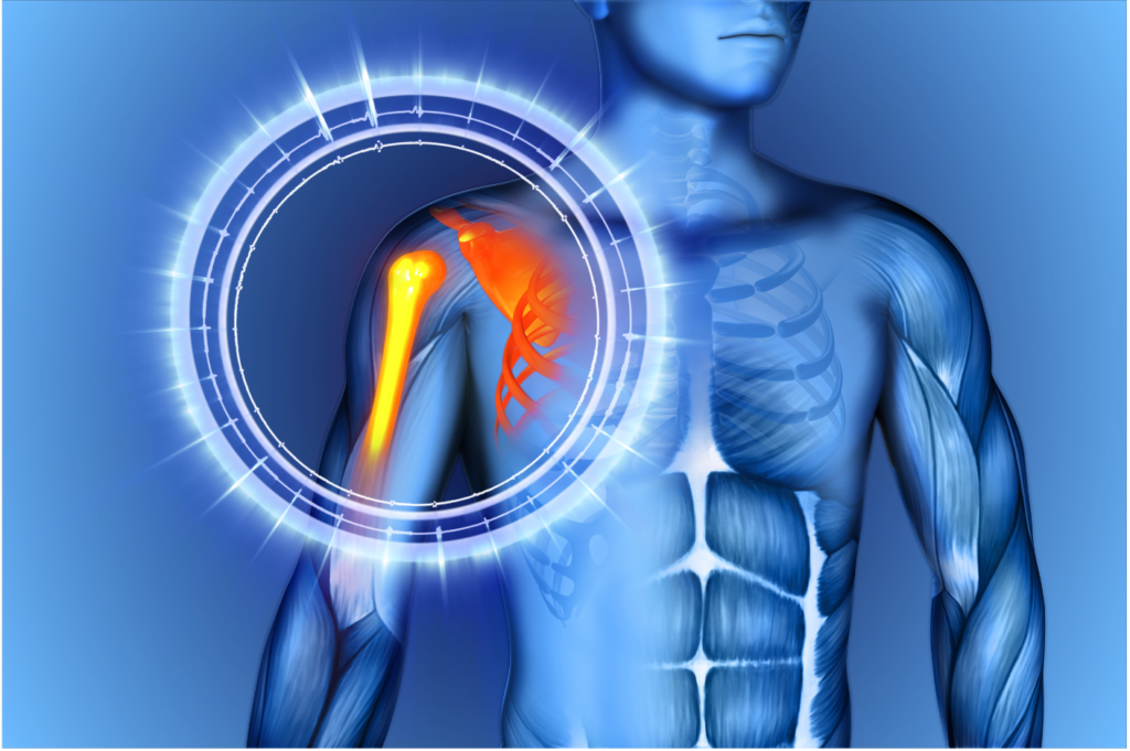 Shoulder Impingement: Symptoms & Treatment