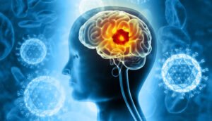 Mini Stroke in Women: Symptoms, Causes, and Treatment