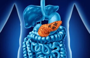 Pancreatic cancer symptoms