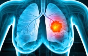 Lung Cancer Symptoms