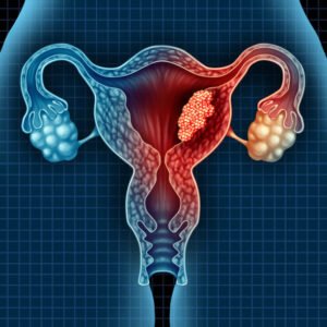 Endometrial Cancer