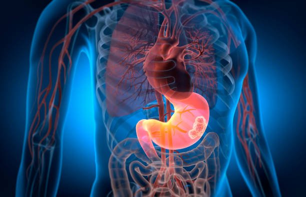 Stomach Cancer Symptoms