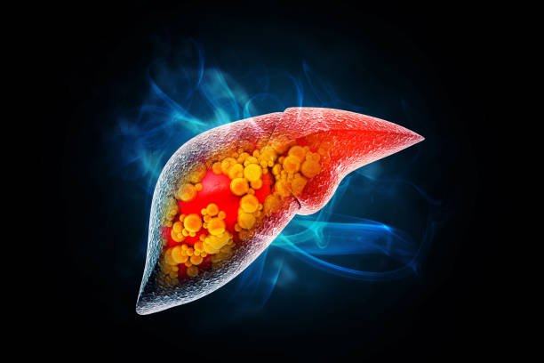 Liver Cancer Symptoms