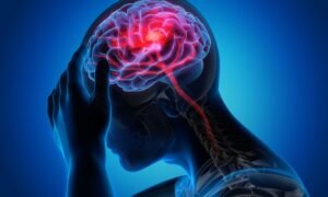 Ocular Migraine Symptoms