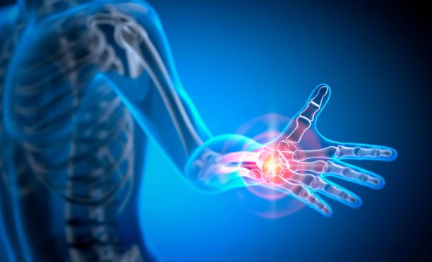 Hand Arthritis Symptoms