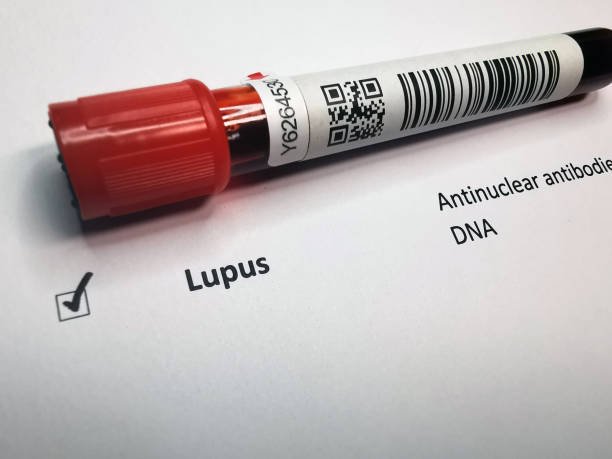 Complete Guide to Childhood Lupus Symptoms and Prevention