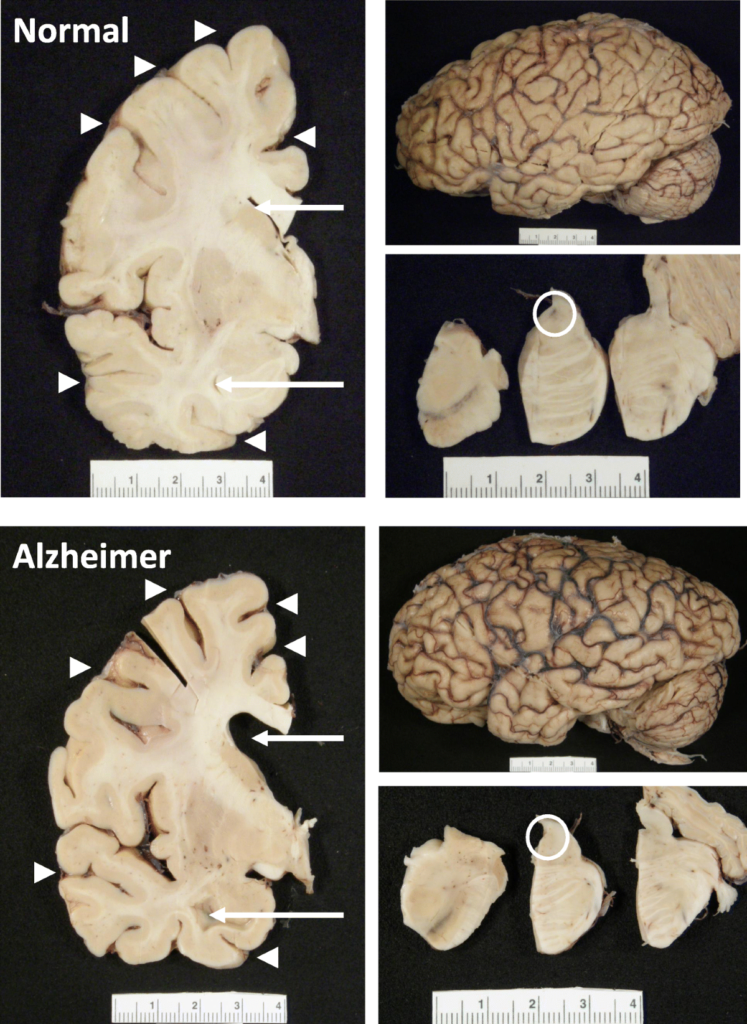 Alzheimer’s Disease: Symptoms, Causes & Treatment