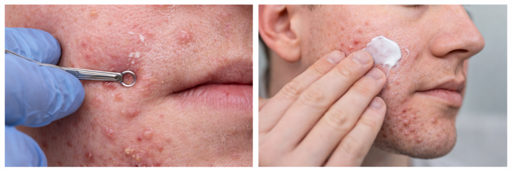 Acne, Causes and Treatment