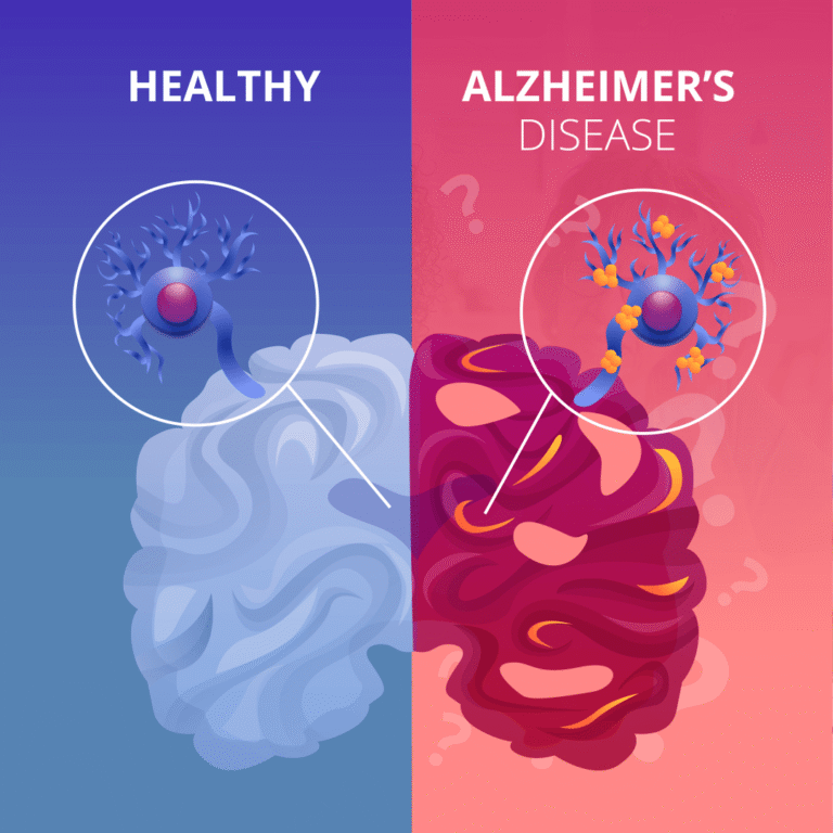 Alzheimer’s Disease: Symptoms, Causes & Treatment