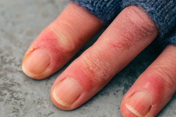 Frostbite Symptoms: A Comprehensive Guide to Staying Safe in Cold Weather
