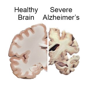 Alzheimer’s Disease: Symptoms, Causes & Treatment