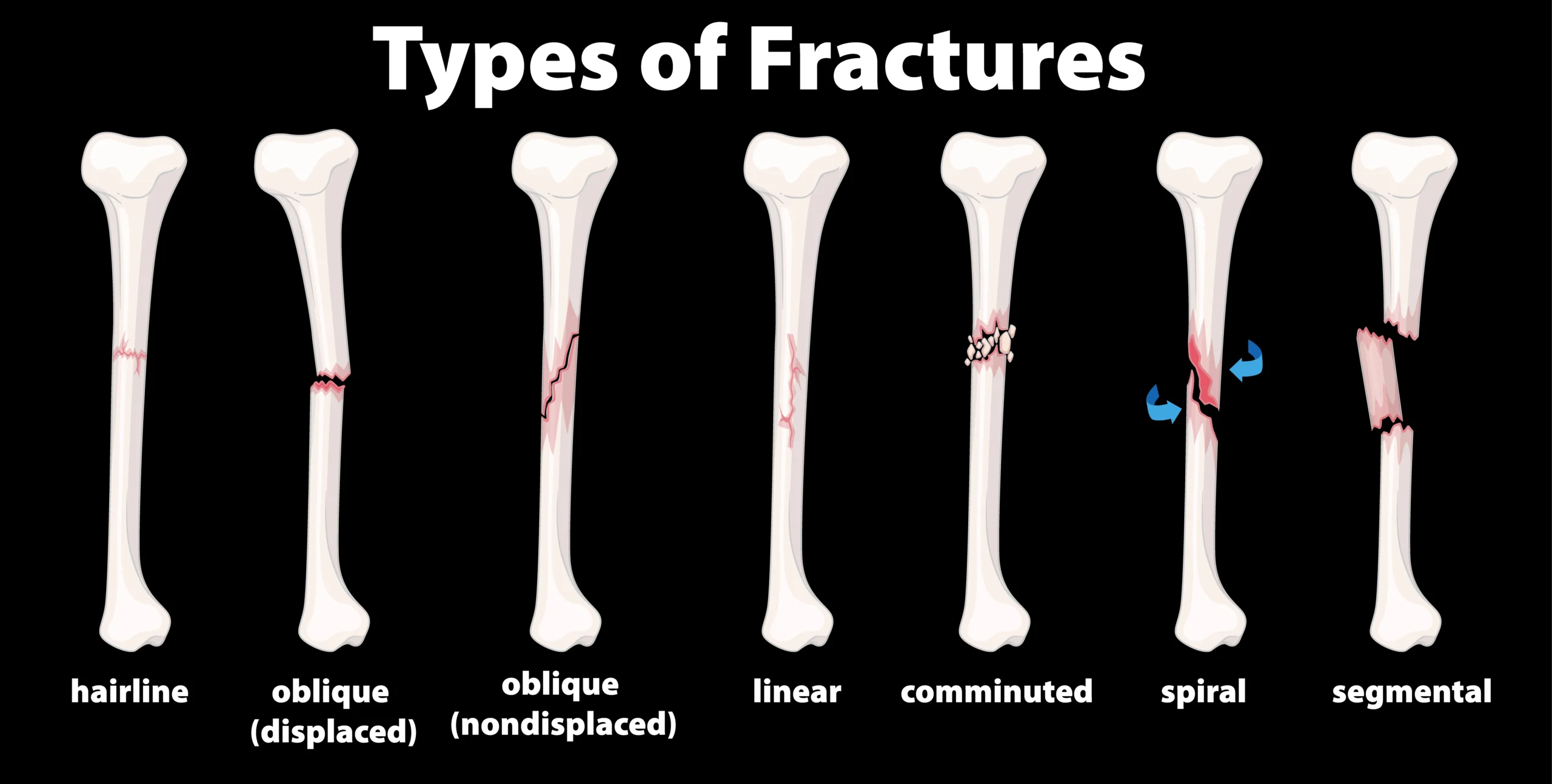 Bone Fracture Guide Symptoms Causes & Treatment