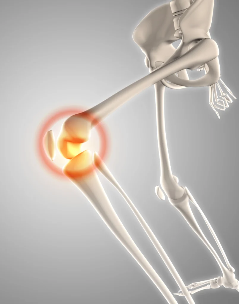 Bone Fracture Guide Symptoms Causes & Treatment