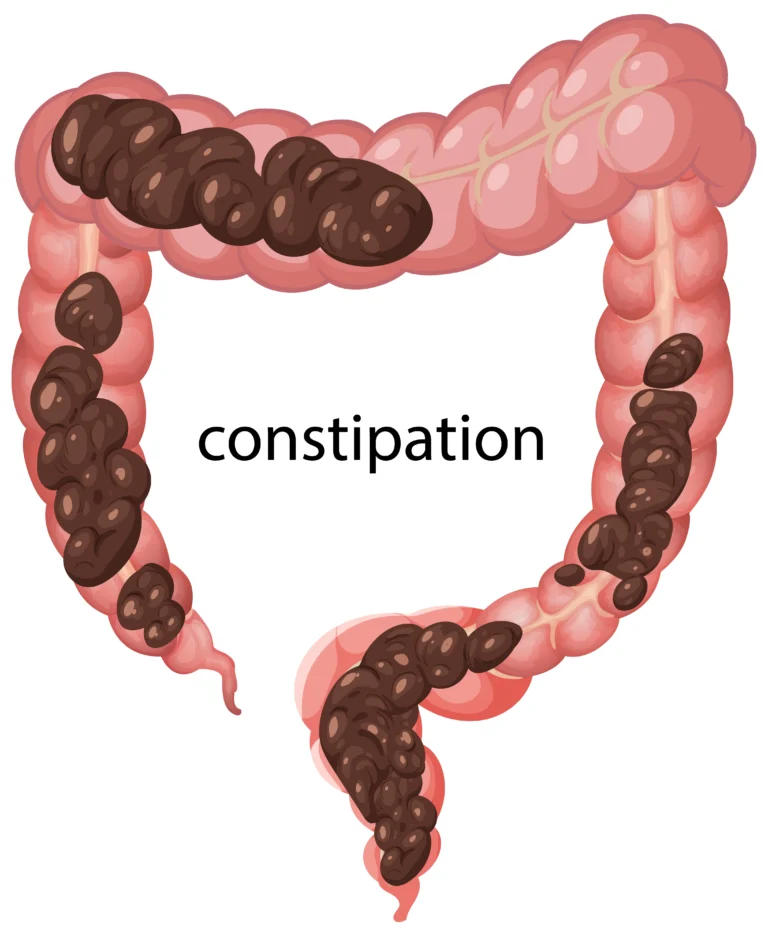 Constipation Symptoms Causes & Treatment Guide