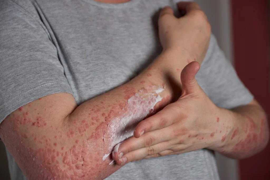 Eczema Symptoms Causes & Treatment Guide