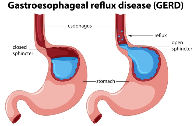 GERD Symptoms, Causes & Treatment Guide
