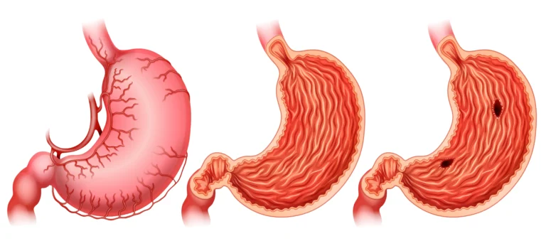 Gastritis Symptoms Causes & Treatment Guide