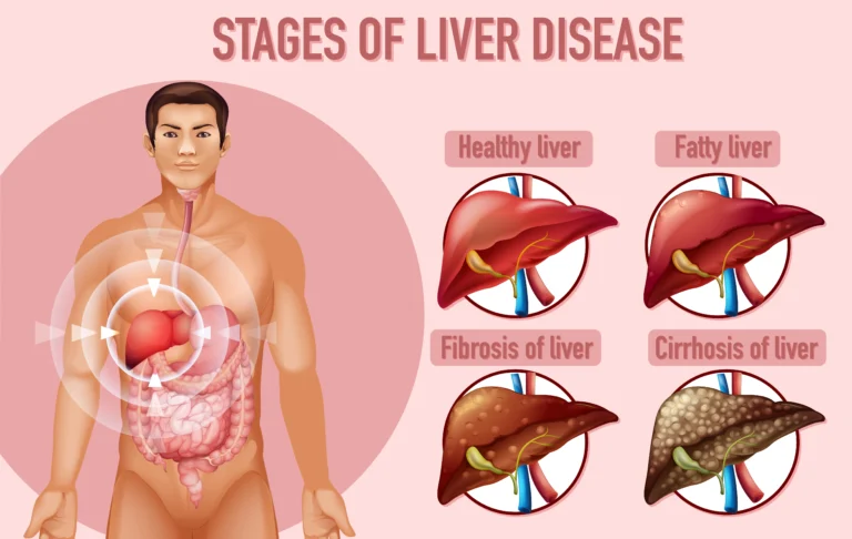 Fatty Liver Disease Symptoms Causes & Treatment
