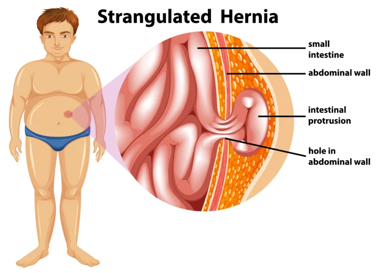 Hernia Symptoms, Causes & Treatment Guide