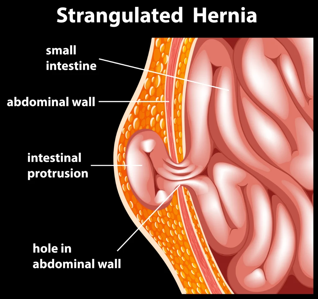 Hernia Symptoms, Causes & Treatment Guide