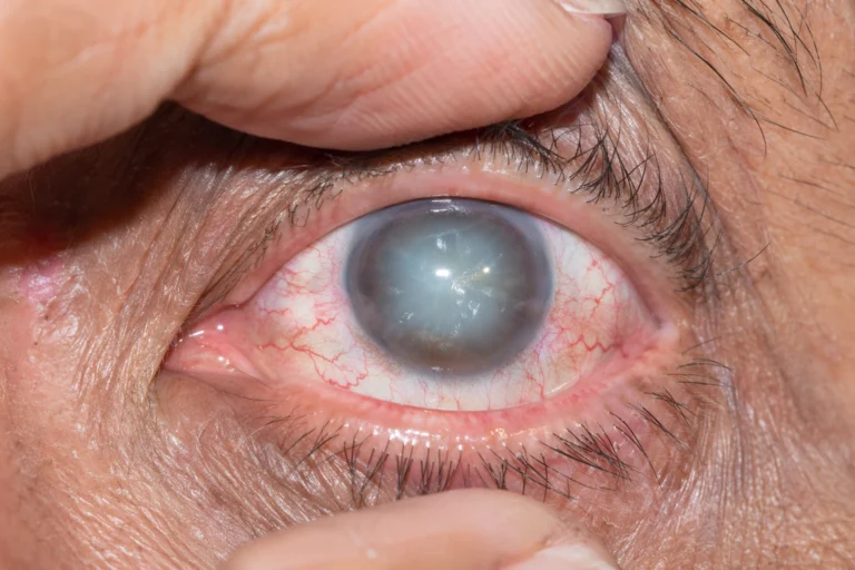 Glaucoma Symptoms Causes & Treatment Guide