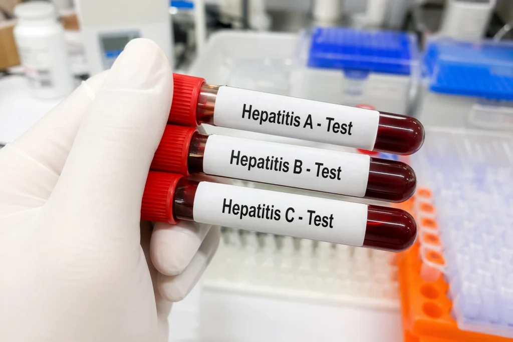 Hepatitis A B CHepatitis A B C: Symptoms, Causes & Treatment