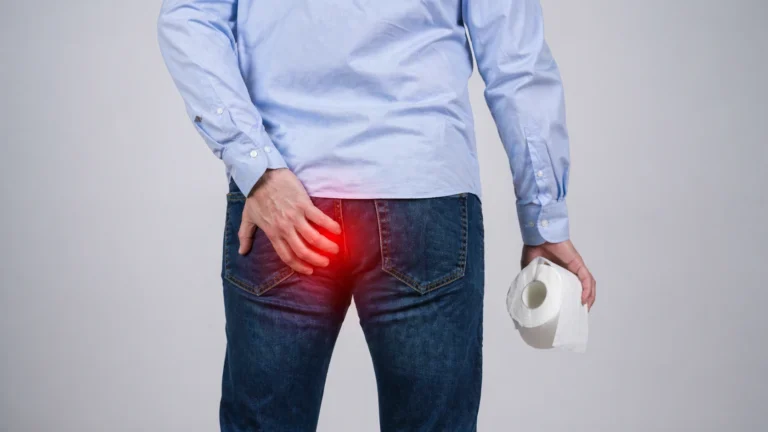 Hemorrhoids (Piles) Symptoms, Causes & Treatment Guide