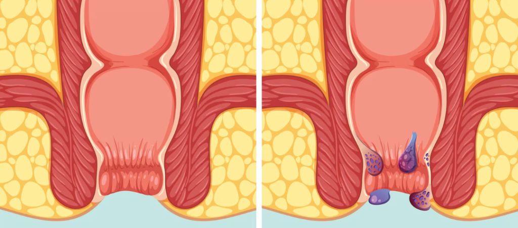 Hemorrhoids (Piles) Symptoms, Causes & Treatment Guide