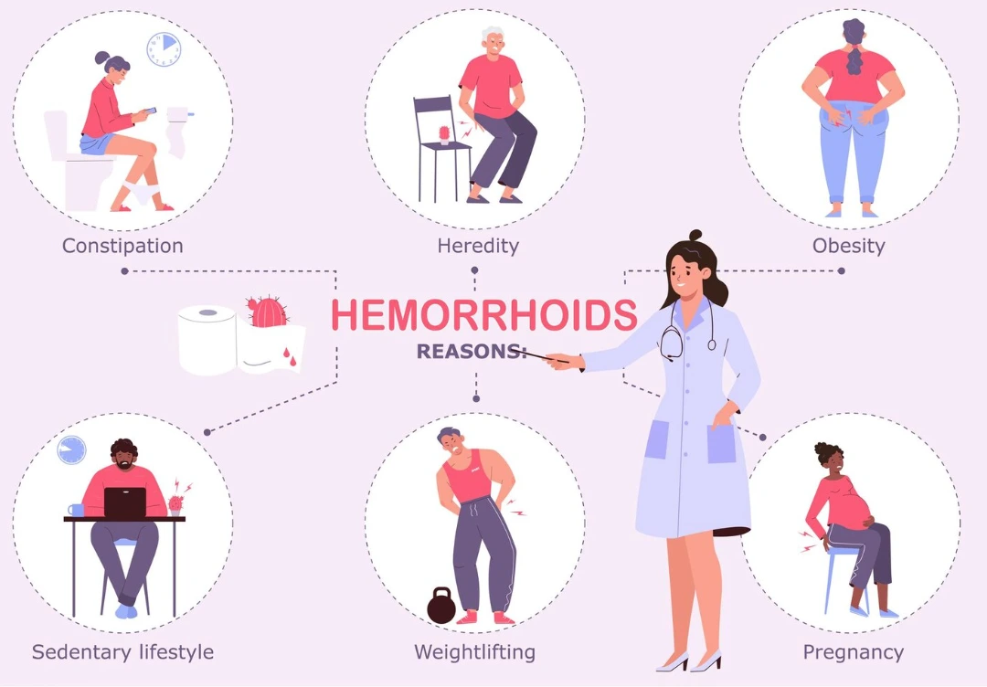 Hemorrhoids (Piles) Symptoms, Causes & Treatment Guide