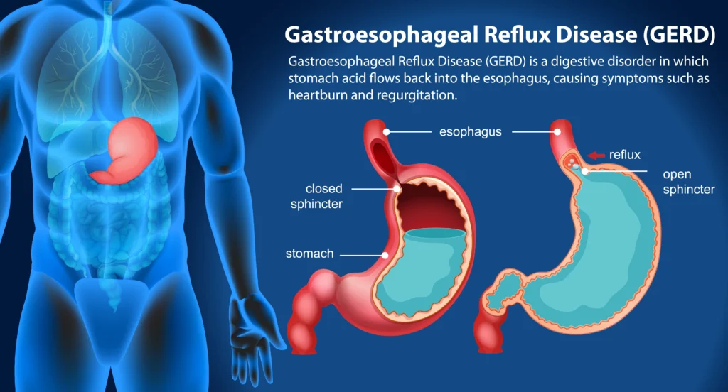 GERD Symptoms, Causes & Treatment Guide