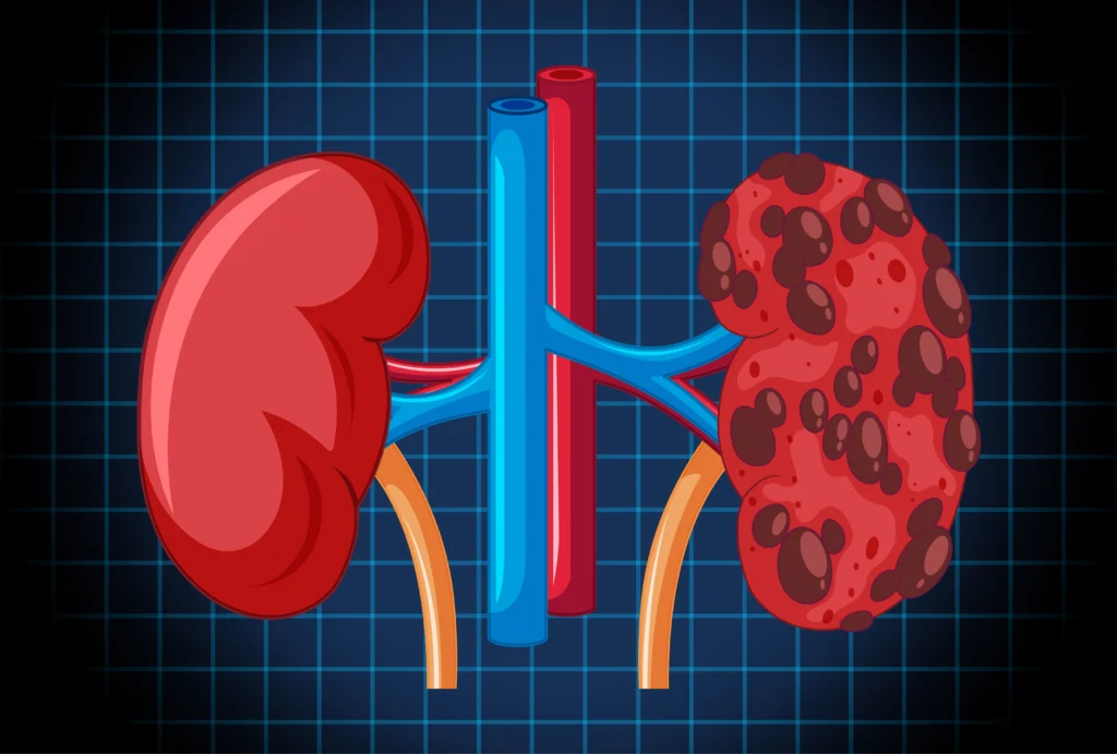 Chronic Kidney Disease Stages, Symptoms & Treatment