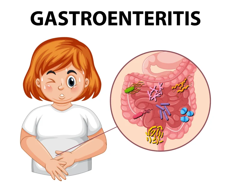 Gastroenteritis Symptoms Causes & Treatment Guide