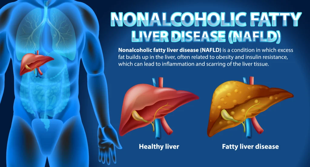 Fatty Liver Disease Symptoms Causes & Treatment