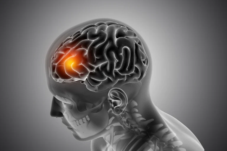 Brain Tumor Symptoms, Causes & Treatment Guide